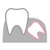 親知らずの抜歯・口腔外科