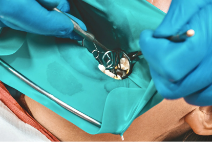 ラバーダム防湿｜再発を防止