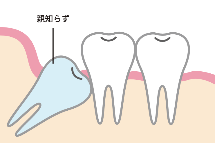 抜いた方が良い親知らず