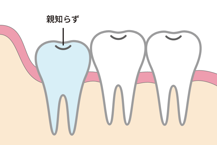 抜かない方が良い親知らず