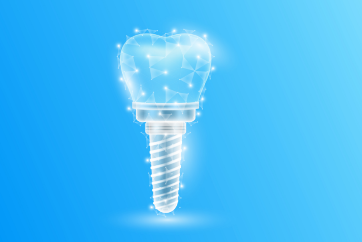 インプラントとは