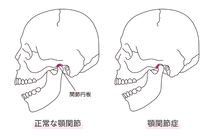 顎関節症とは