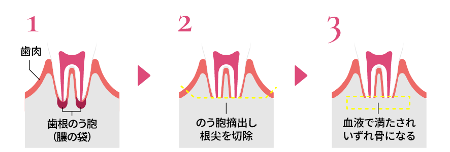 歯根端切除術で抜歯せずに治療