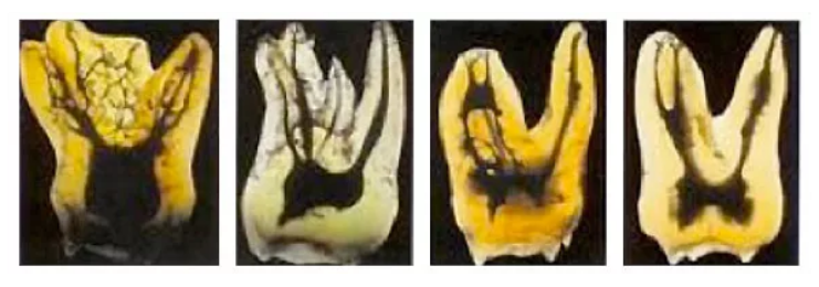 CT検査で複雑な根管を可視化