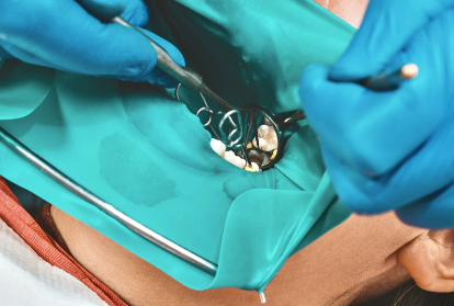 ラバーダム防湿で再感染を防ぐ