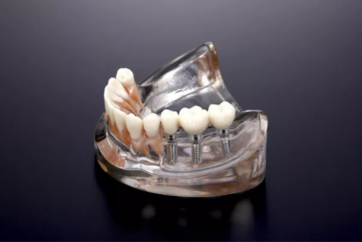 身体に優しいインプラント