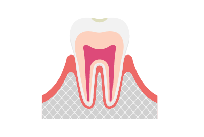 C0（初期の虫歯）