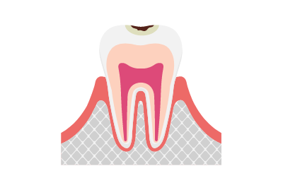 C1（エナメル質の虫歯）