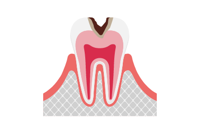 C2（象牙質まで進行した虫歯）