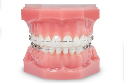 表側矯正｜透明なワイヤー