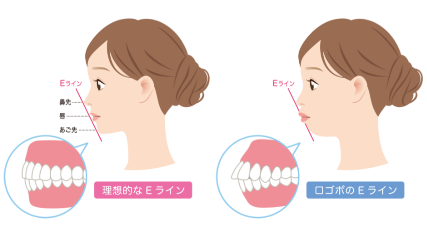 Eライン・フェイスラインを意識した治療