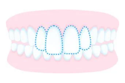 部分矯正｜すきっ歯出っ歯の治療