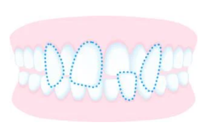 後戻り矯正｜歯並びが戻ってしまった人へ