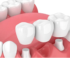 一般的なブリッジ