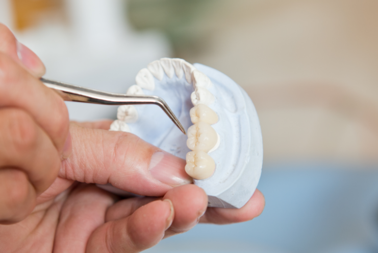 「仮歯」での微調整