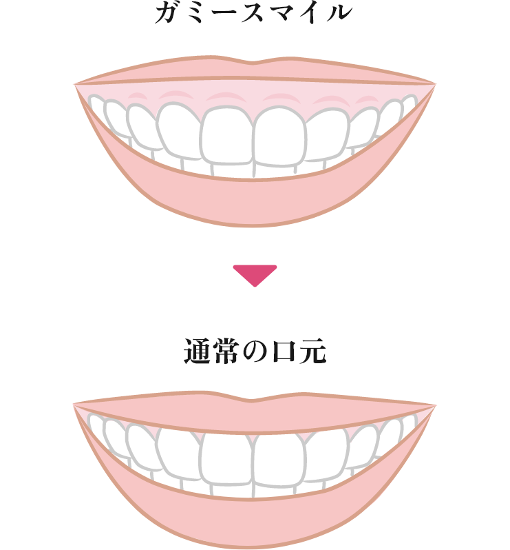 ガミースマイルも改善