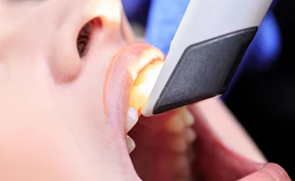 口腔内スキャナーによる快適な型取り